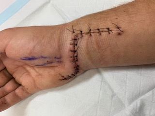Benny Nelson injury pic wrist